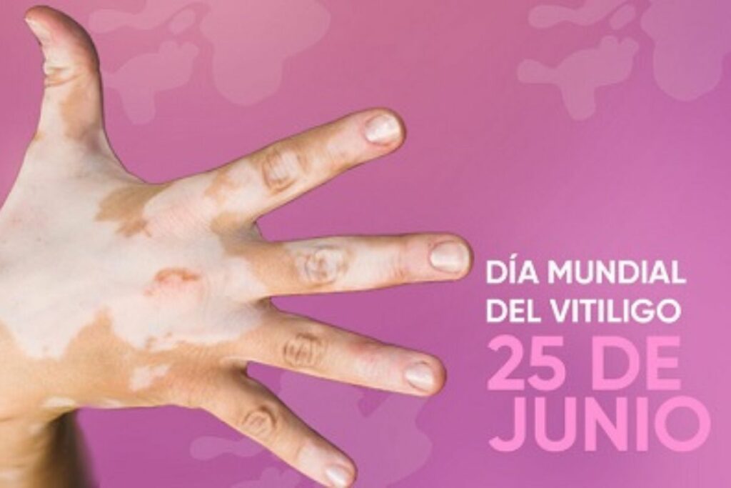 El vitiligo, una condición que causa manchas blancas debido a la pérdida de melanocitos. Foto: especialidades.sld.cu.