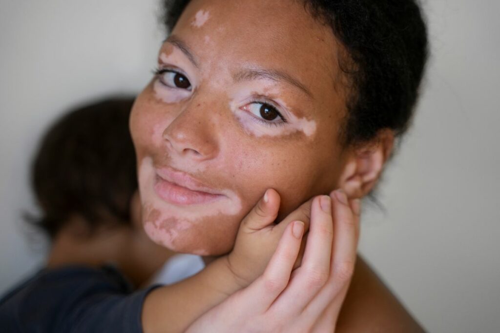 El primer Día Mundial del Vitiligo se estableció el 25 de junio de 2011 en honor a Michael Jackson. Foto: Freepik.